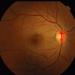Figure 1: Fundus photograph showing bilateral macula oedema with yellow subretinal deposits and dot haemorrhages
